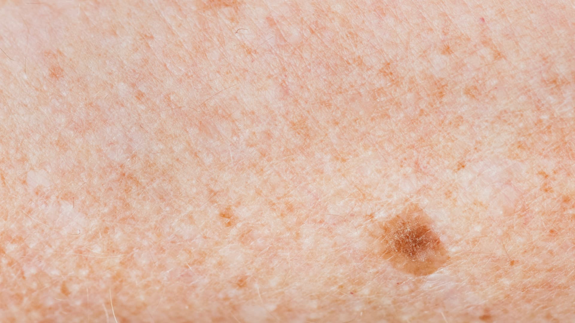 Keratosis Seboroik: Gejala dan Penyebab