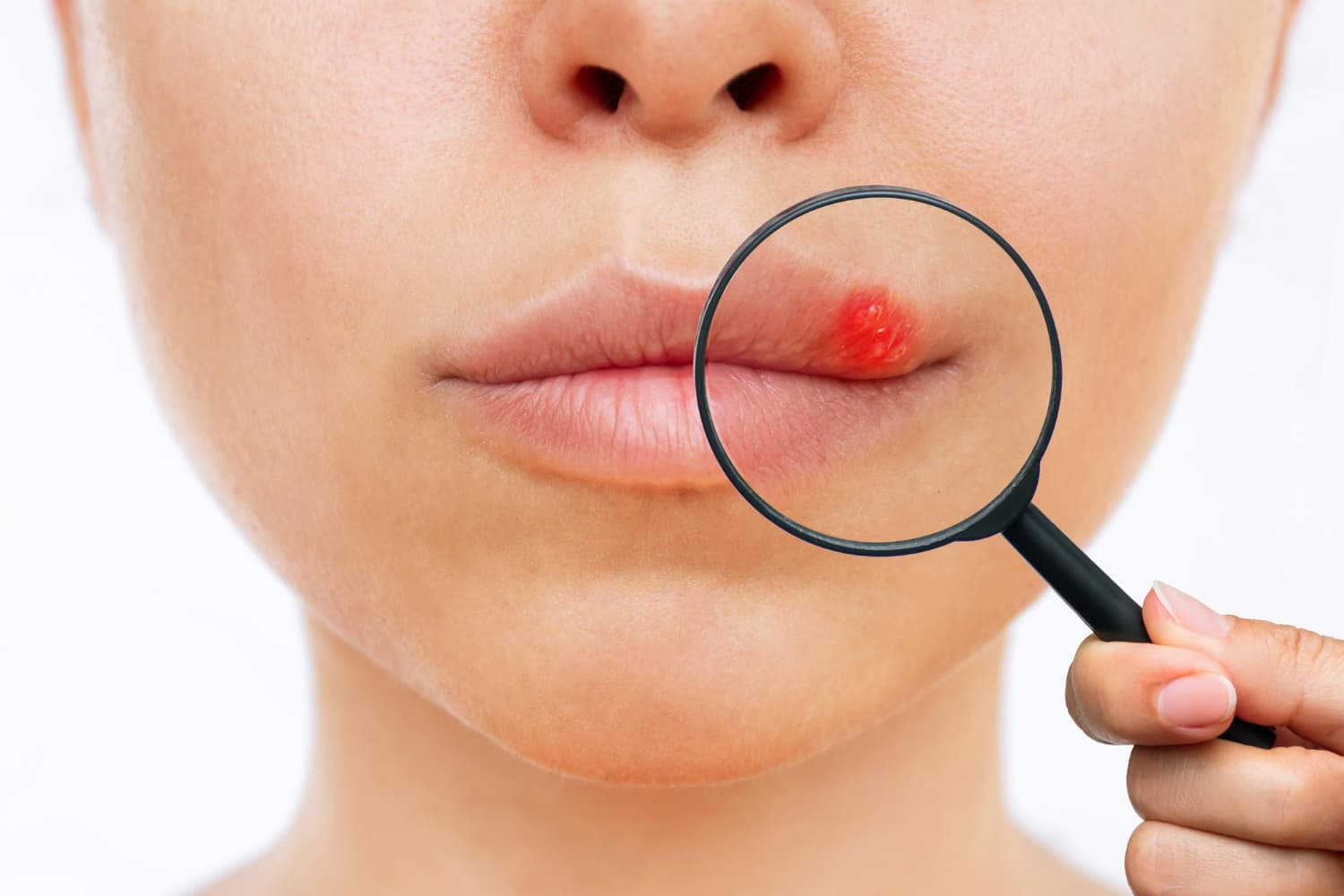 Jamur di Bibir: Ciri, Penyebab, dan Cara Mengatasinya agar Tidak Mudah Kambuh