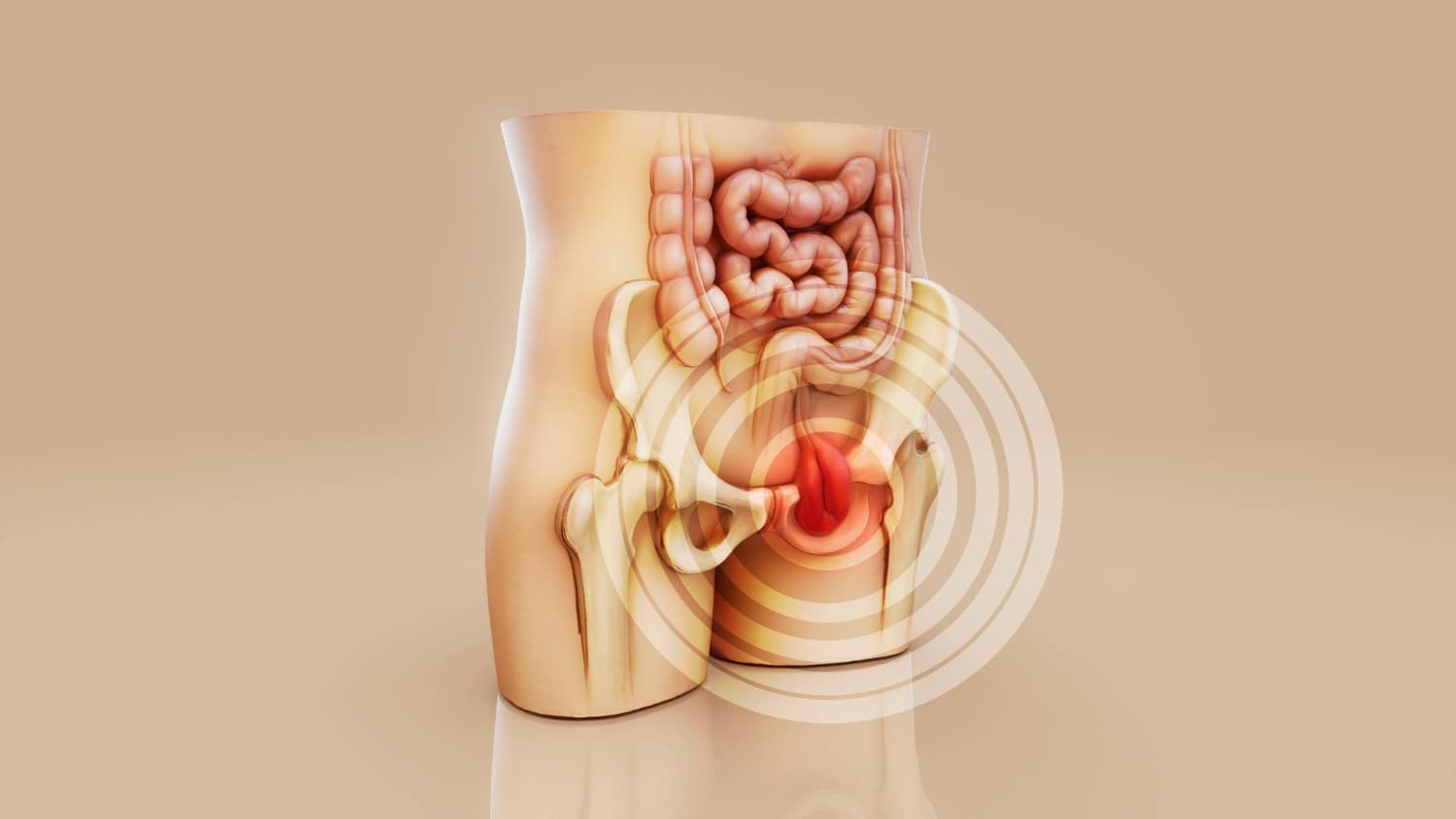 Hernia Inguinal: Penyebab, Gejala, Bahaya, dan Cara Mengatasinya