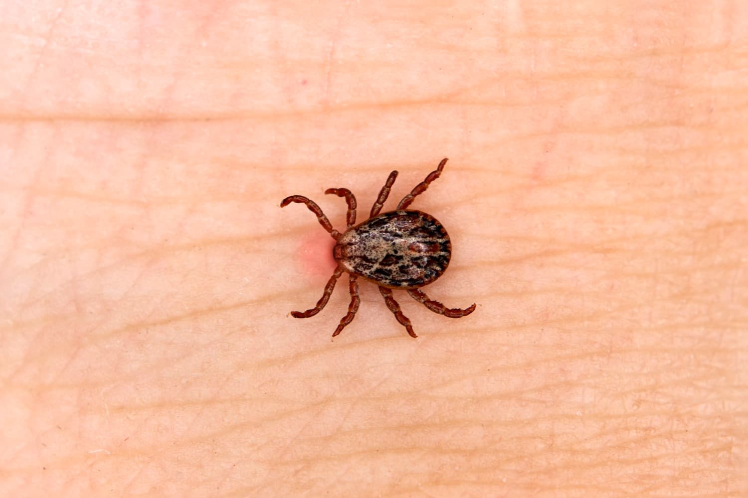 Penyakit Lyme: Penyebab, Gejala, Pengobatan, dan Pencegahannya