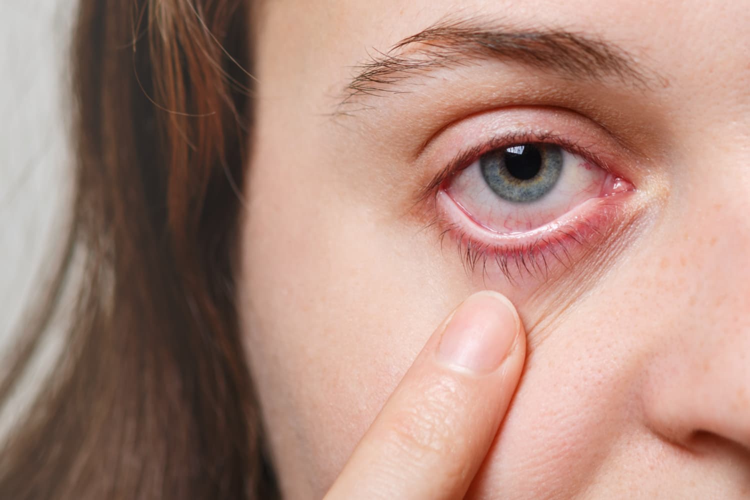 Episkleritis: Gejala, Penyebab, dan Mengobatinya