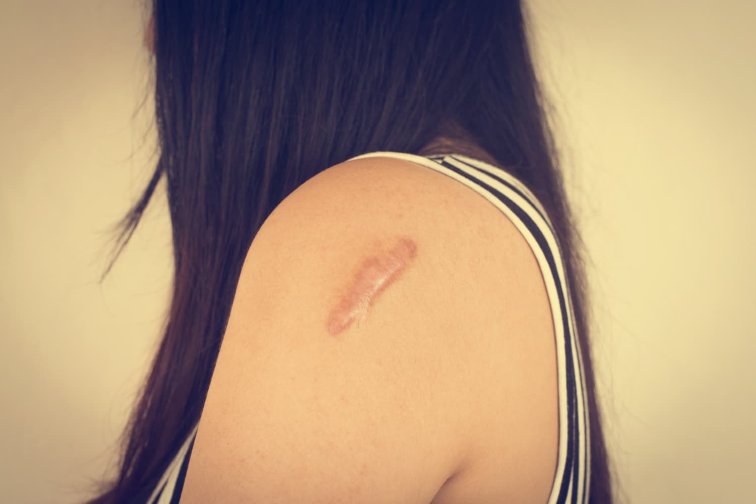 Keloid: Penyebab, Gejala, Pengobatan, dan Cara Mencegahnya