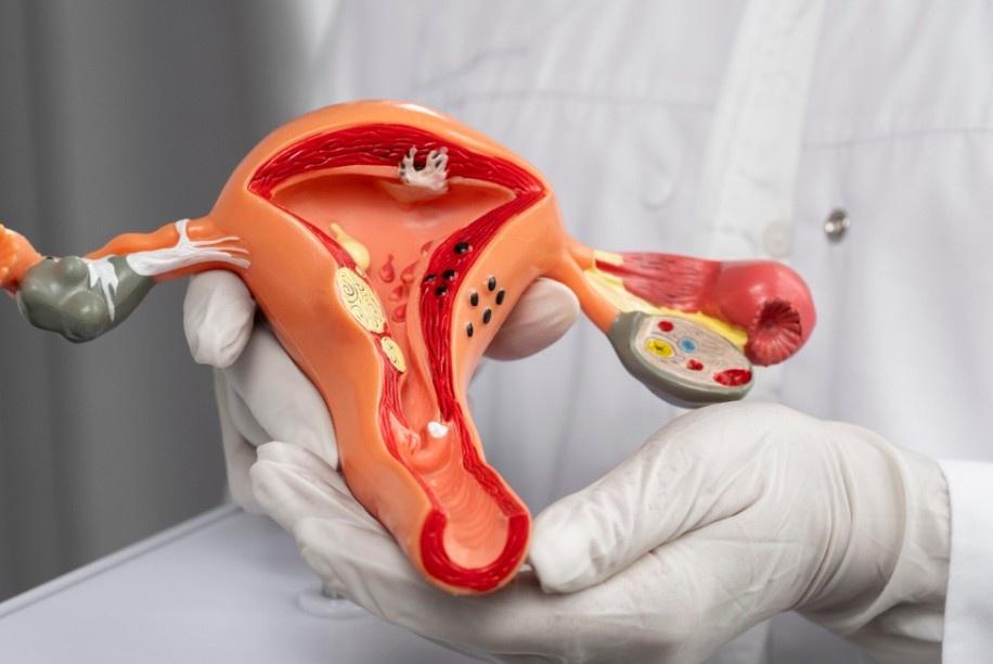 penyebab-kista-endometriosis