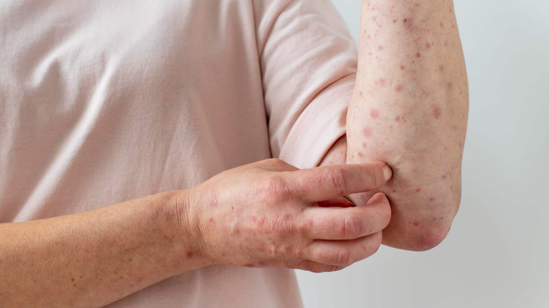 Cacar Api Adalah Herpes Zoster, Kenali Gejala dan Cara Mengobatinya