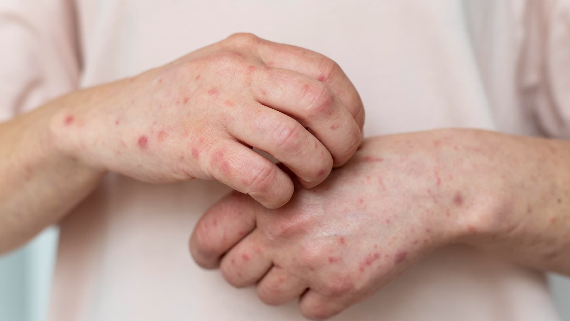Dermatitis Atopik pada Bayi: Penyebab, Gejala, dan Cara Merawatnya