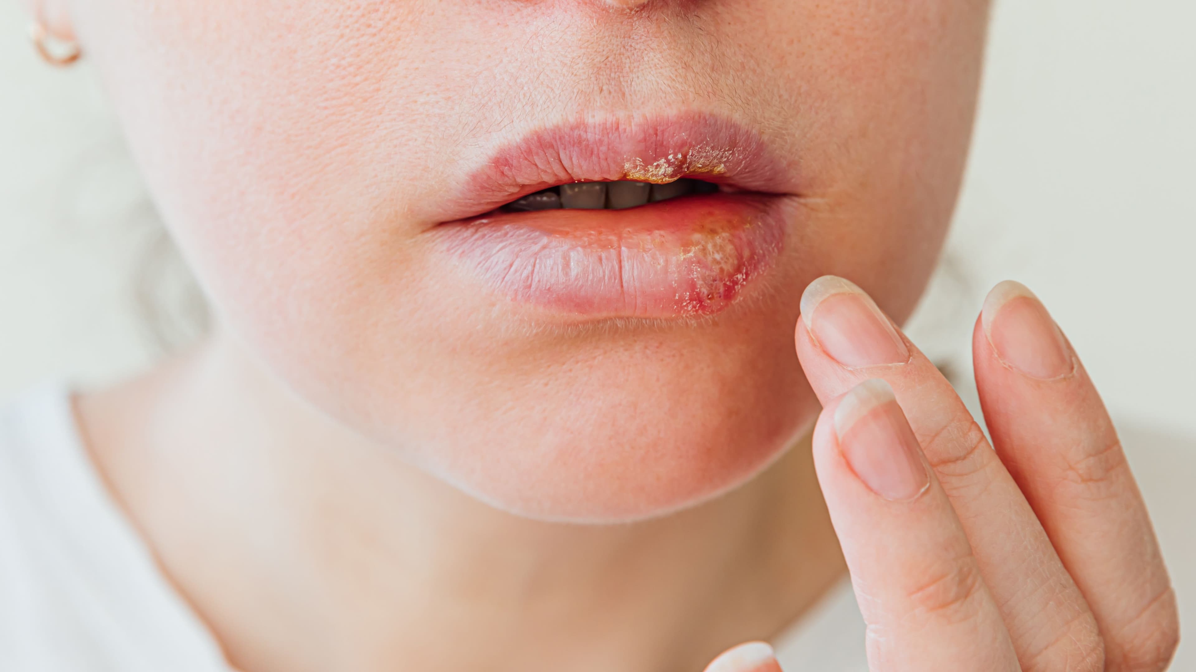 bibir herpes