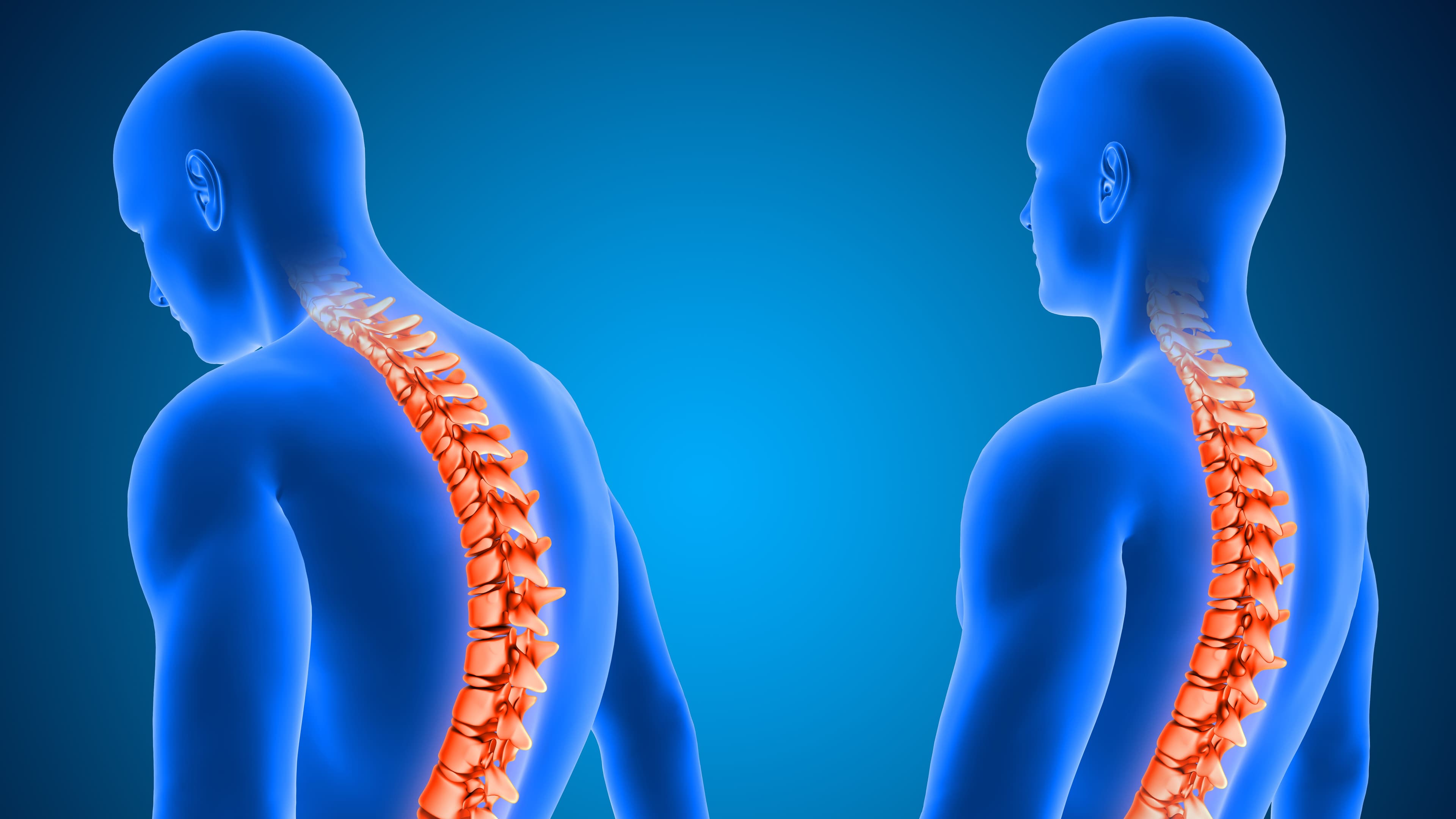 Penyebab Lordosis