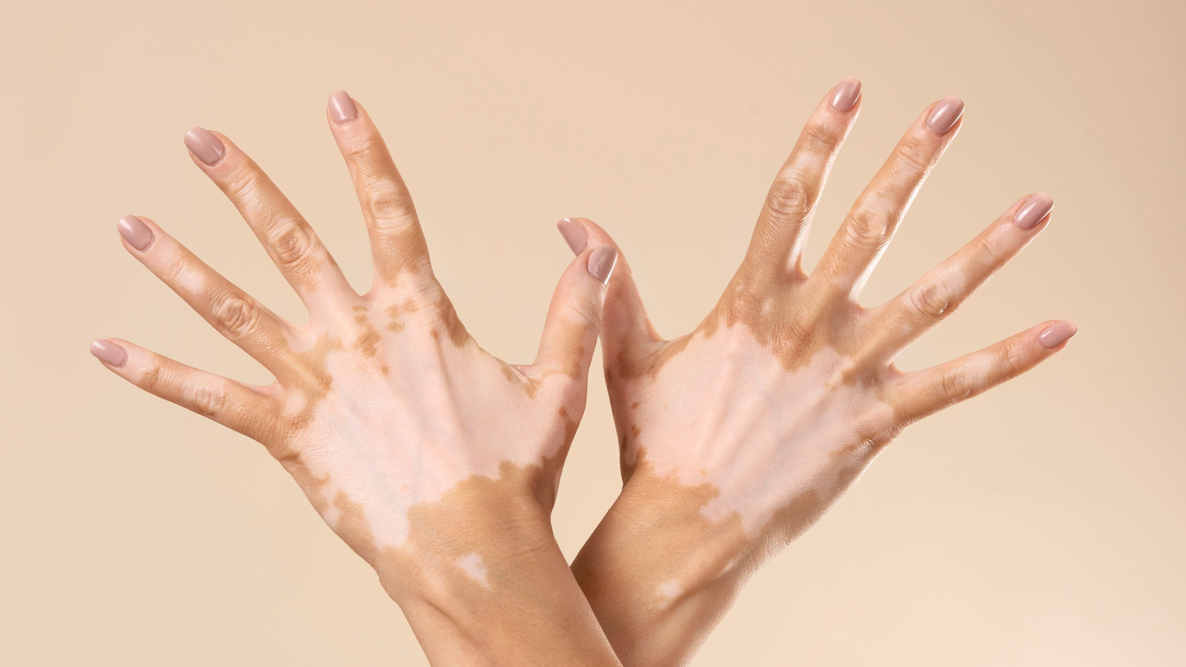 Penyebab Vitiligo