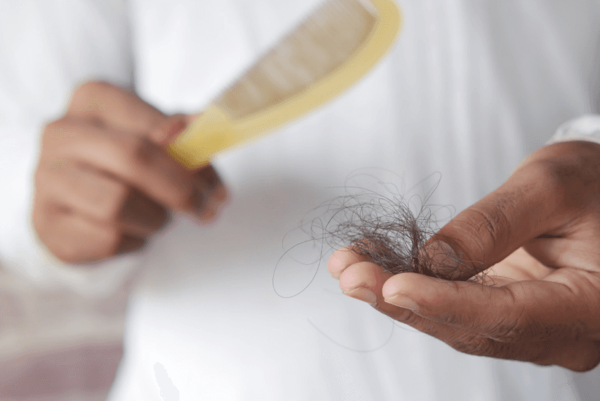 Menganal Alopecia Areata: Penyebab dan Pengobatannya