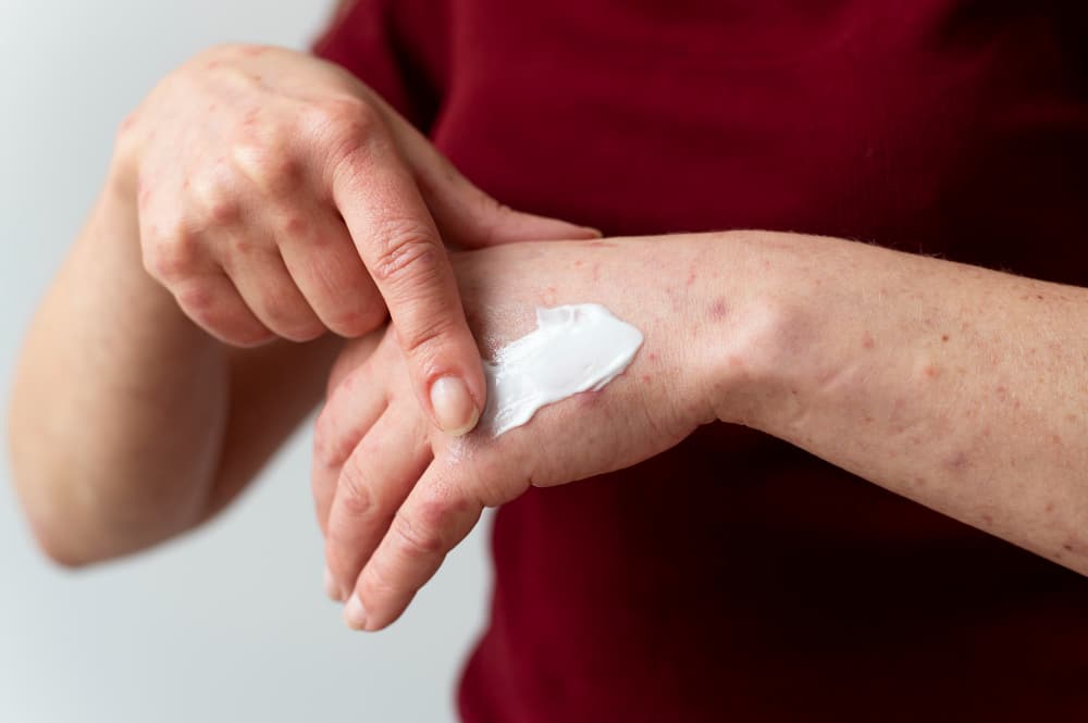 Gejala Diabetes pada Kulit: Gatal, Bercak Gelap, dan Kapan Perlu Cek Gula Darah