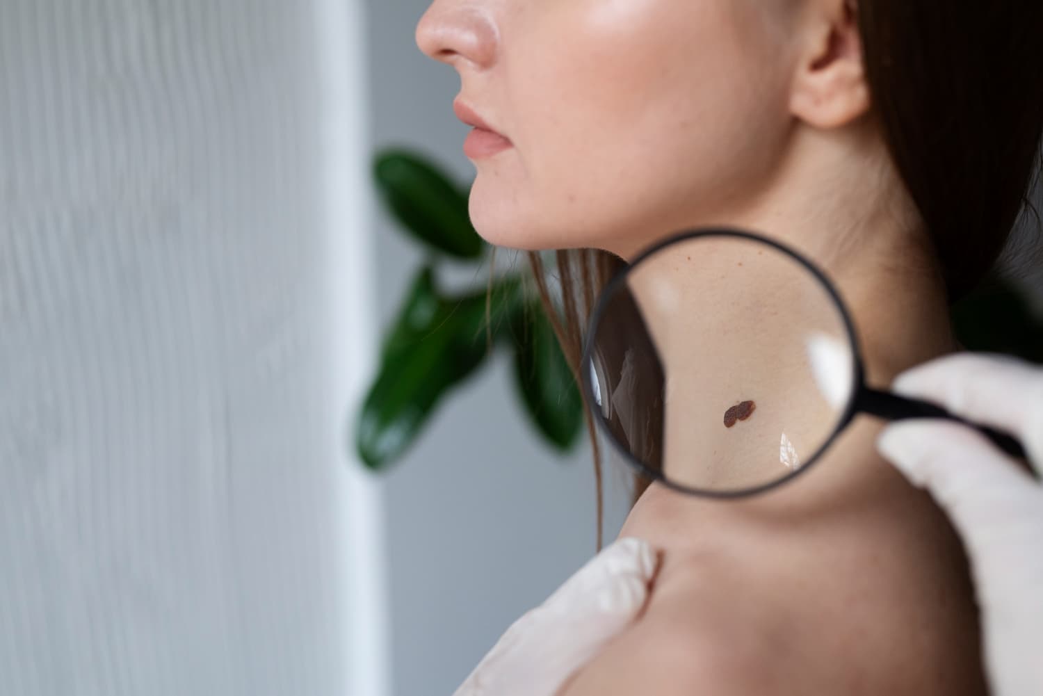 Melanoma Adalah Jenis Kanker Kulit: Kenali Penyebab, Gejala, dan Pengobatannya