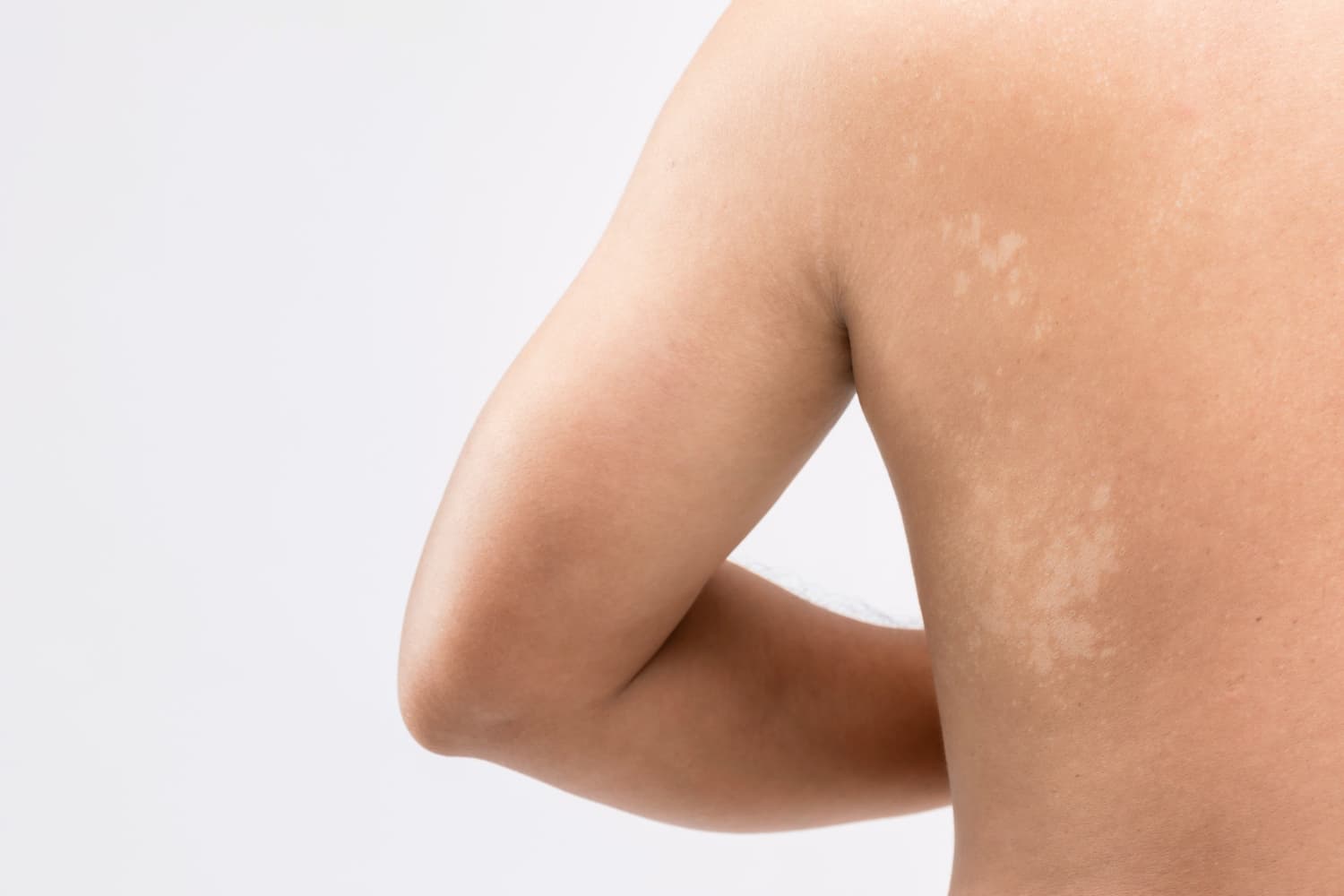 Penyebab Panu, Ciri-Cirinya di Badan dan Wajah, serta Cara Menghilangkannya