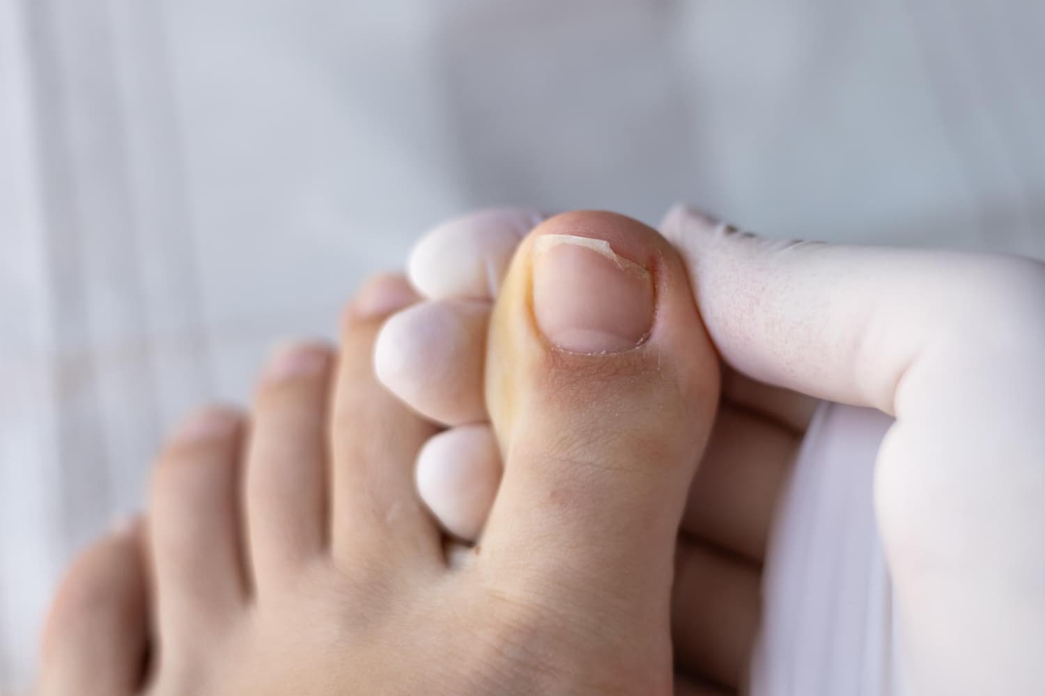 Kuku Cantengan: Penyebab, Perawatan di Rumah, dan Tanda Perlu ke Dokter