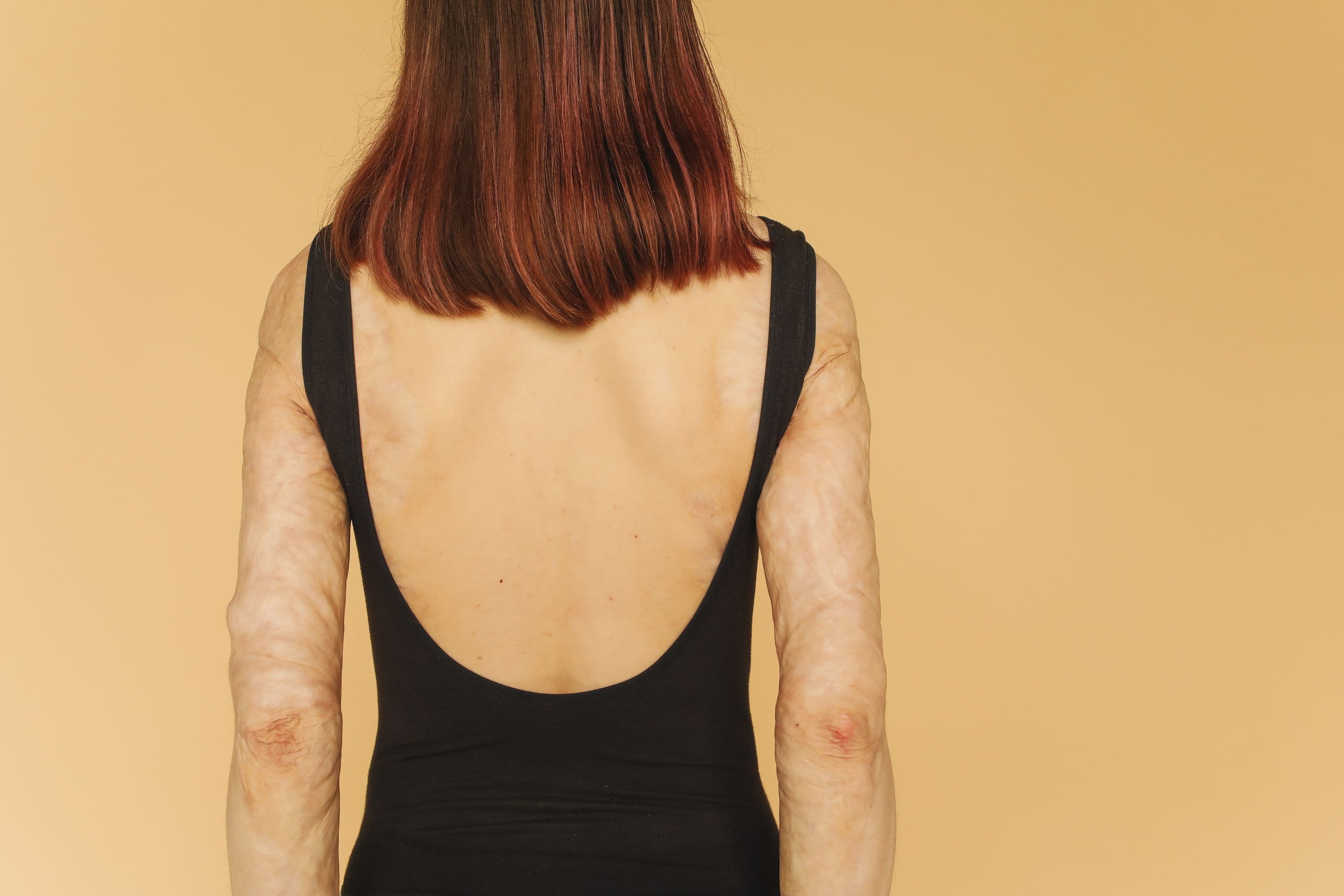 Apa Itu Neurofibromatosis? Kenali Gejala dan Penyebabnya