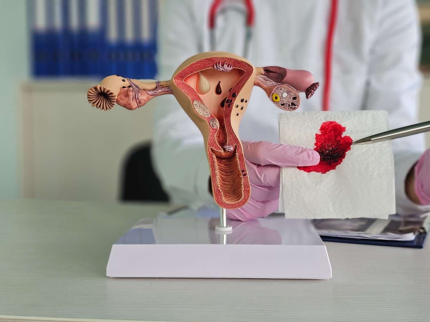 Miom Adalah Tumor Jinak Rahim, Seberapa Berbahayakah Kondisi Ini?