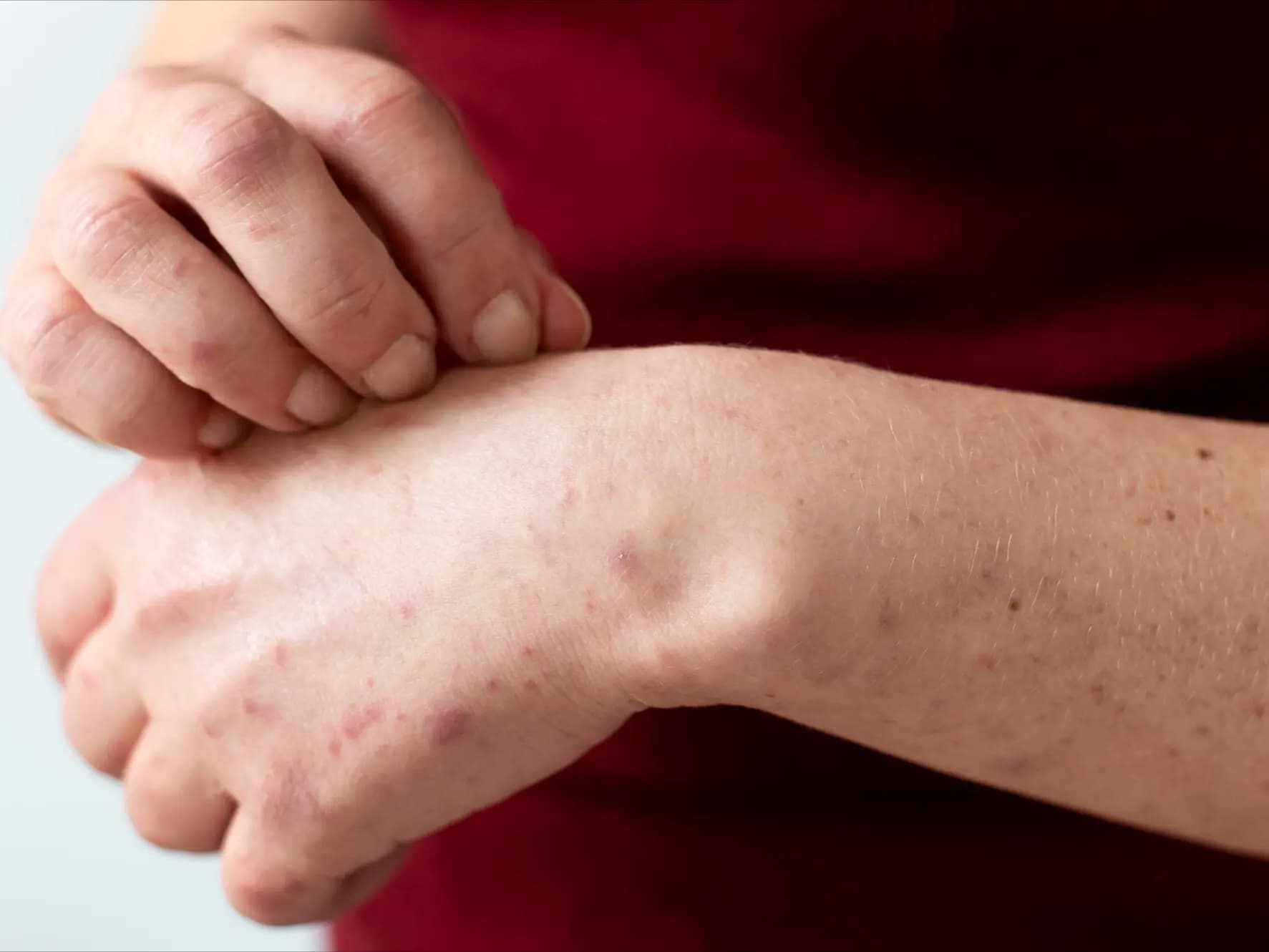 Psoriasis: Mengenal Penyakit kulit yang Lebih dari Sekedar Ruam