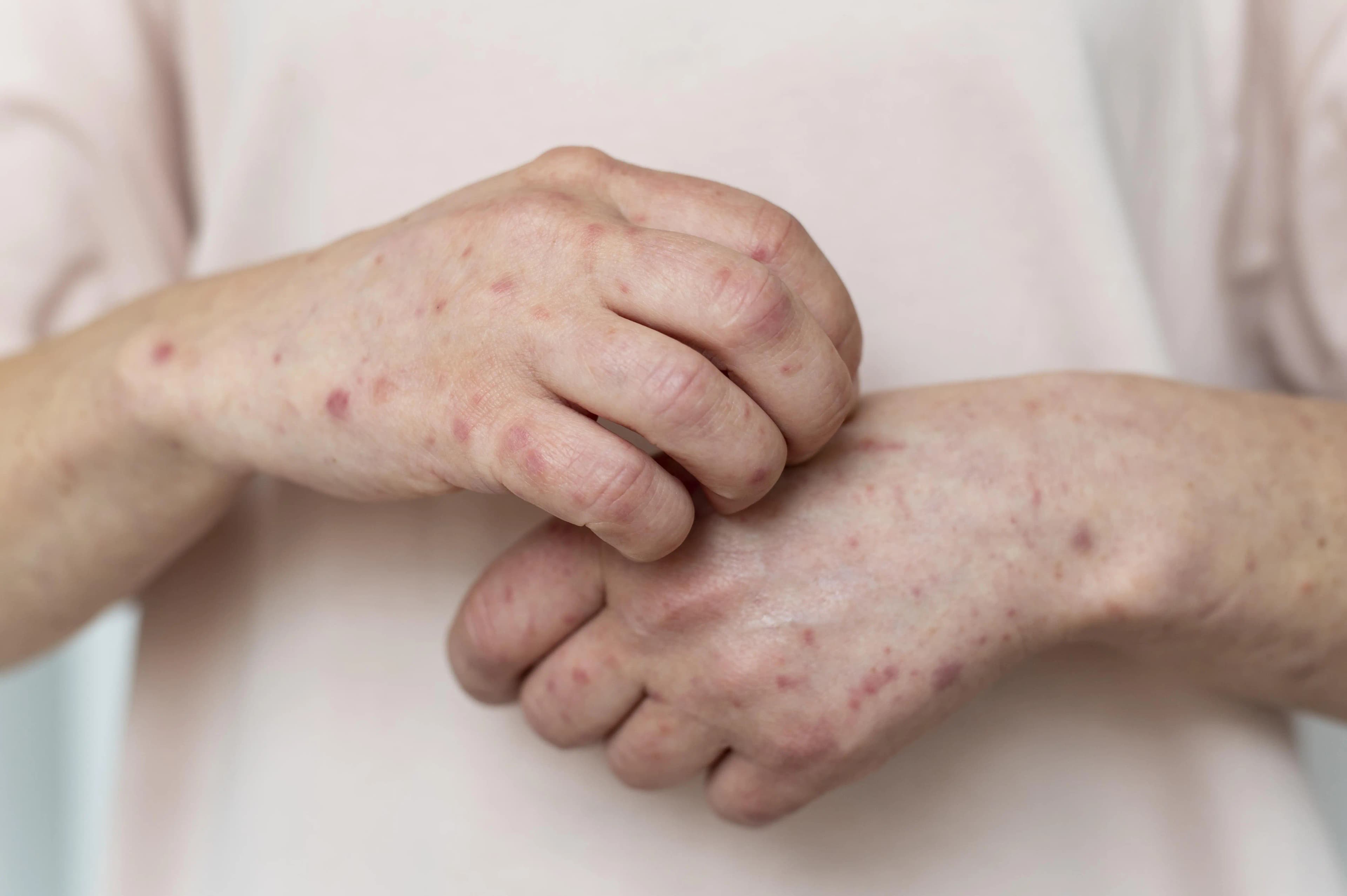 Vaksin MMR: Lindungi Anak dari Campak, Gondongan & Rubella