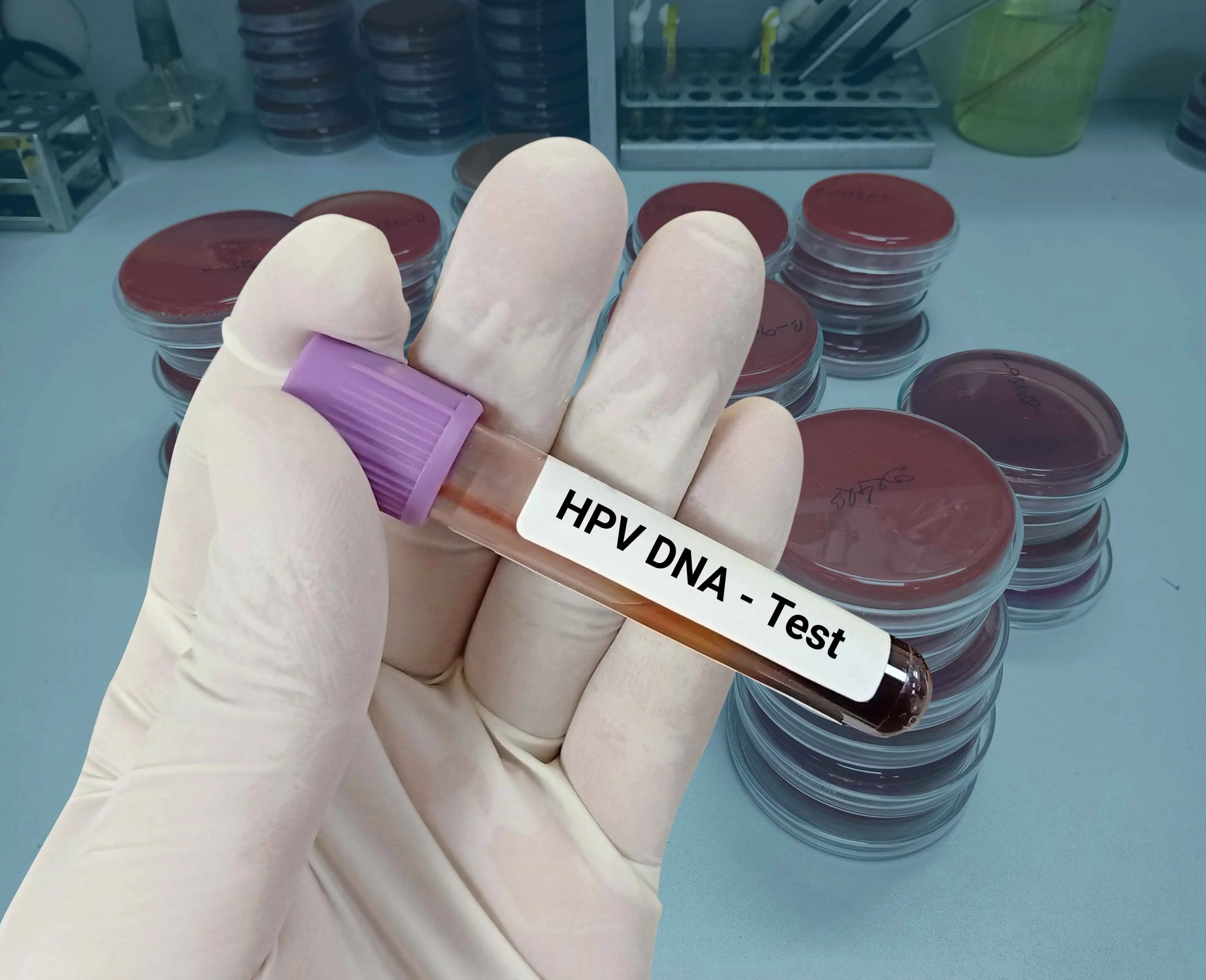 tes hpv dna di bumame