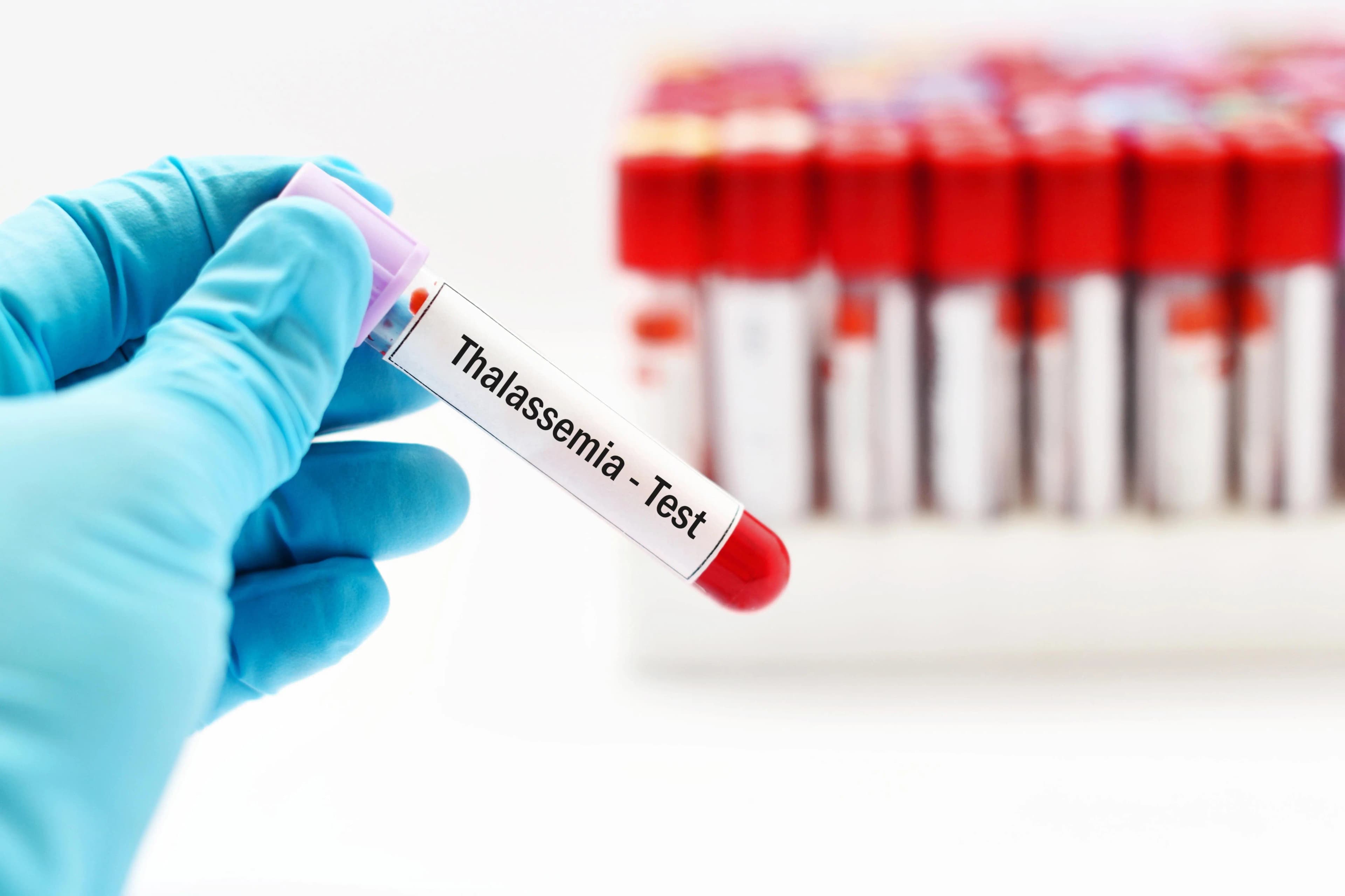 Kenali Thalassemia: Penyakit Keturunan yang Sering Dianggap Biasa
