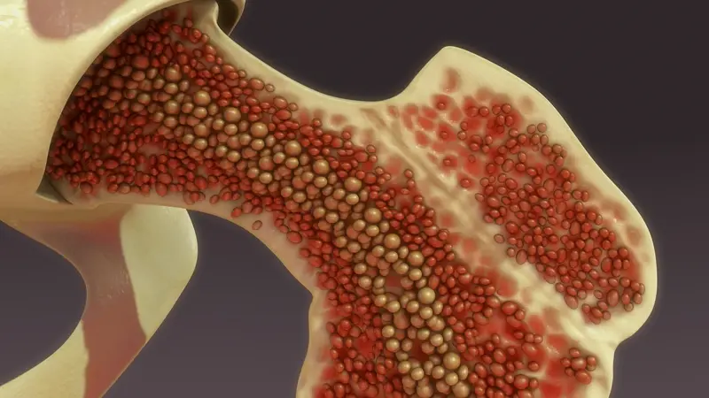 Bone Marrow Puncture: Menyingkap Rahasia Kesehatan dari Dalam Tulang