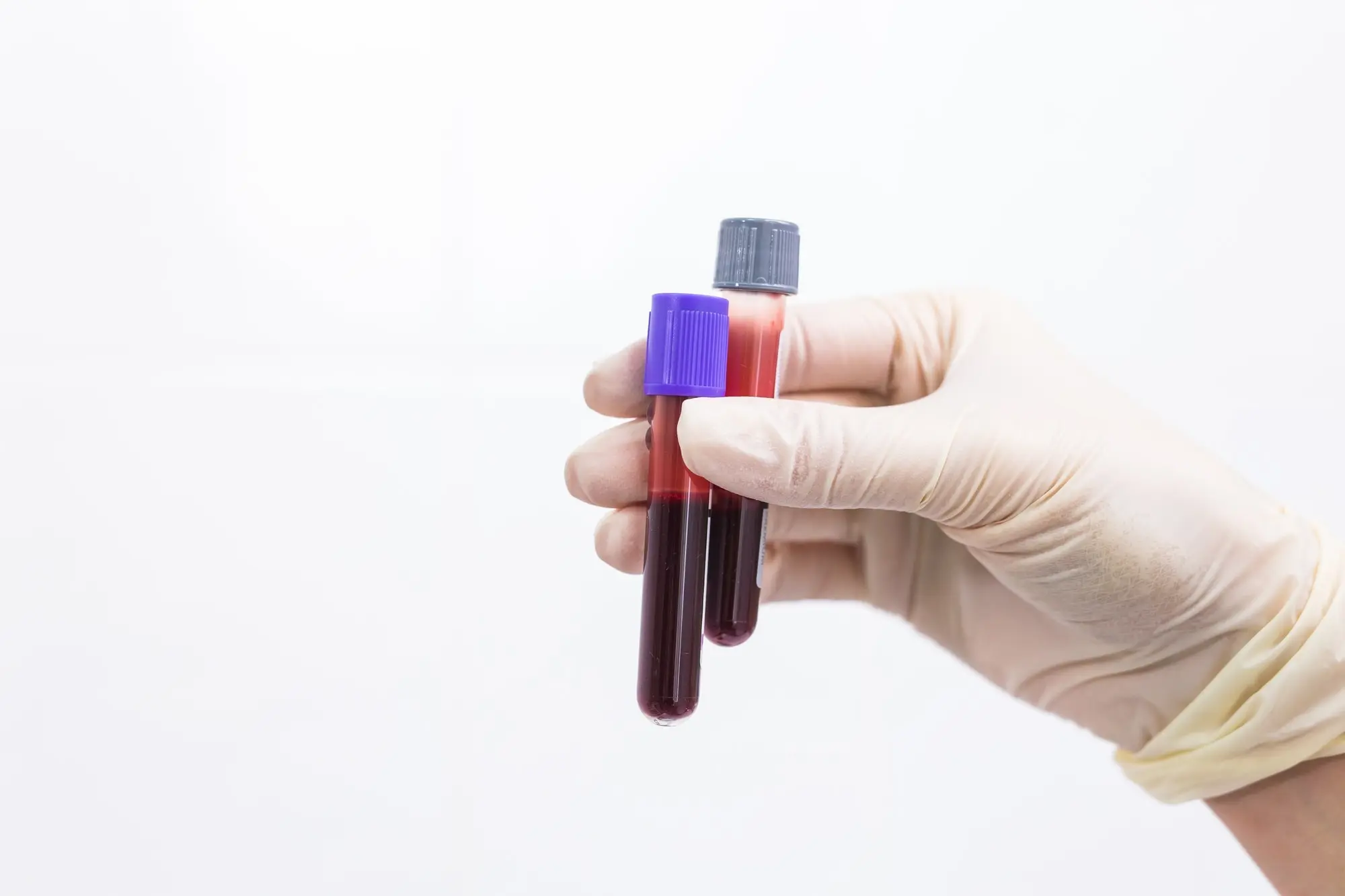 Mengenal Hepatitis C: Menular Lewat Darah, Ini Panduan Lengkapnya!