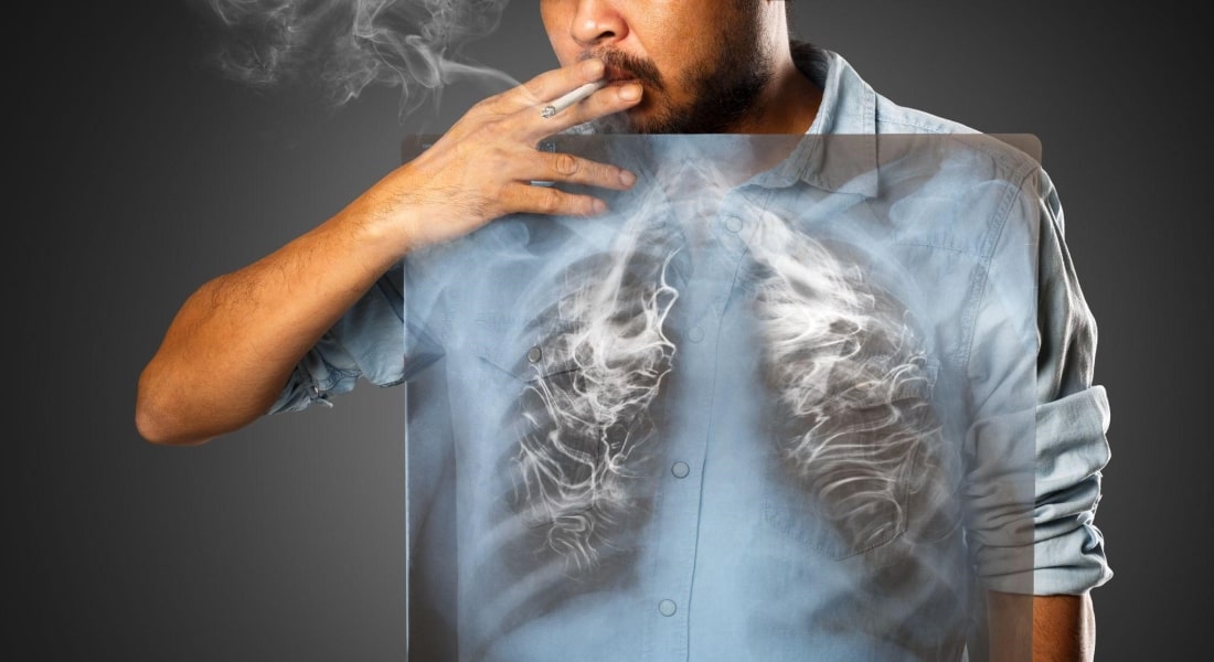 perokok kanker paru paru